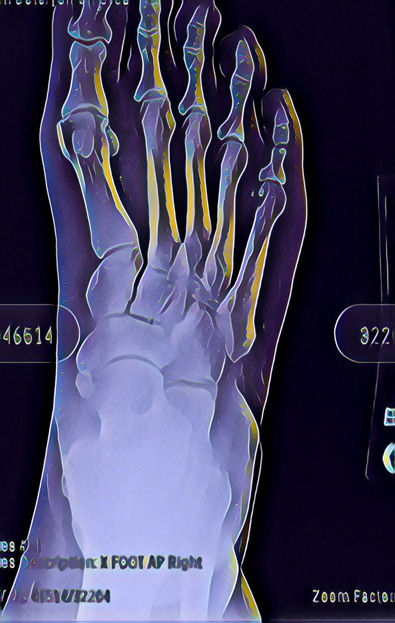 Metal Art Sign - X-Ray Foot Bones Abstract Medical Wall Decor Purple